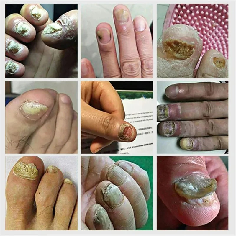 Nail fungus gel