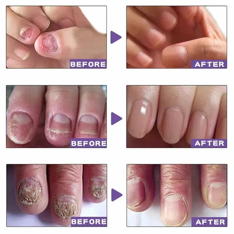 Nail fungus gel