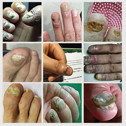 Nail fungus gel